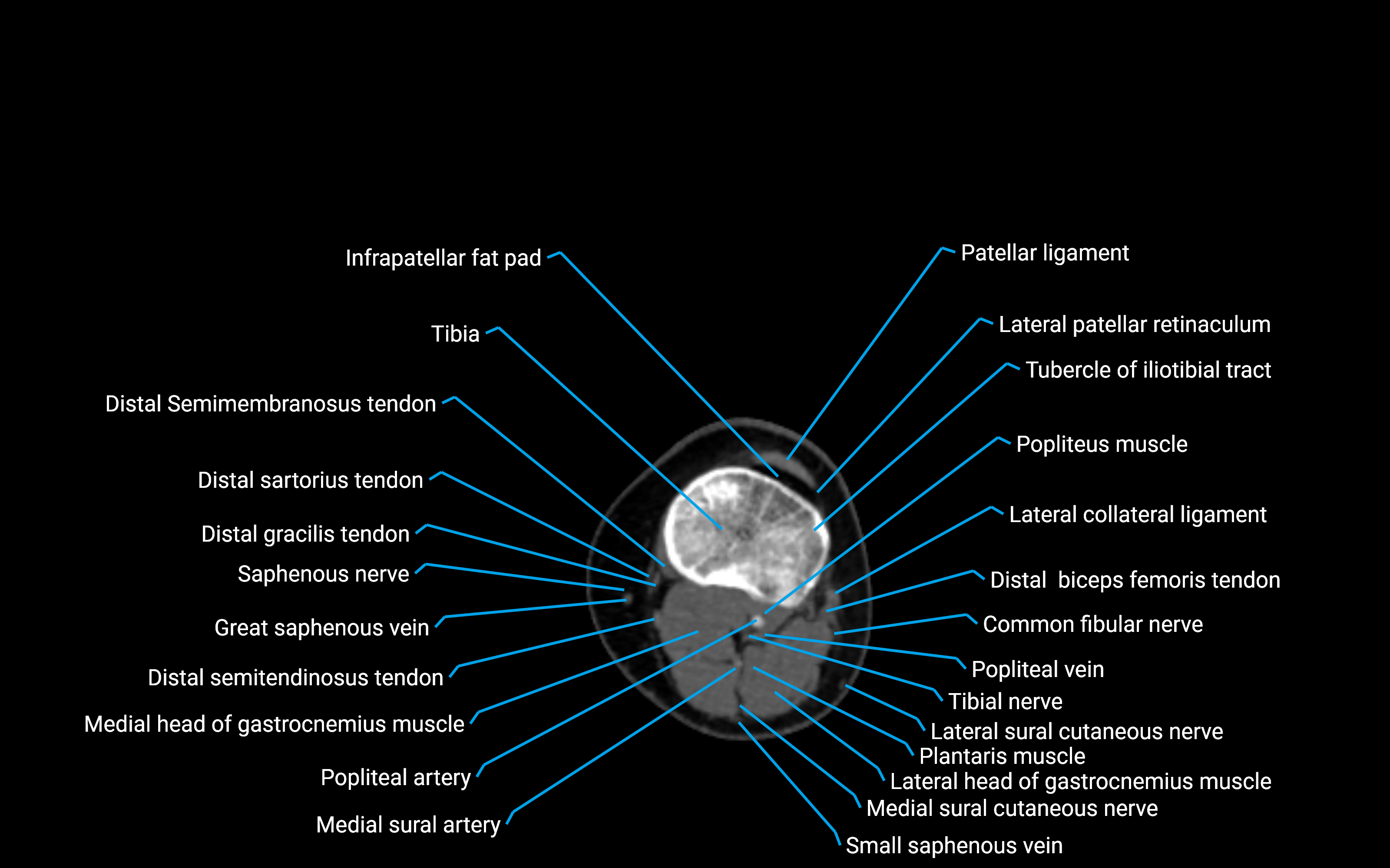 CT Lower leg axial cross sectional anatomy labelled image 93 (2).png